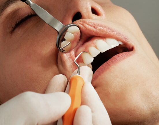 Extractions For Permanent and Wisdom Teeth